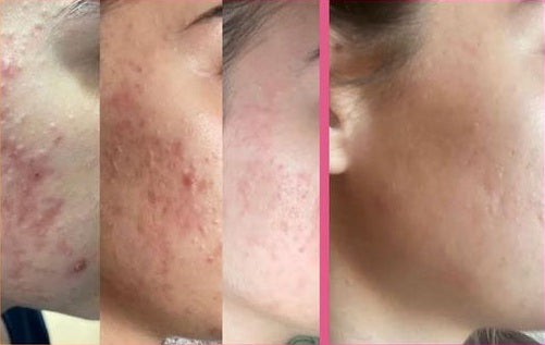 Training Excellence Acne treatment (voorschot betaling)