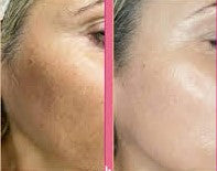Training Excellence Pigment treatment (voorschot betaling)